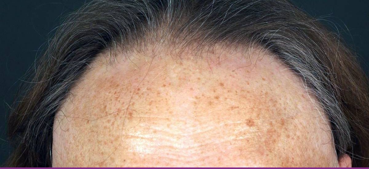 Alopecia Fibrosante Frontal