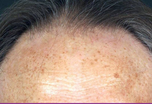 Alopecia Fibrosante Frontal