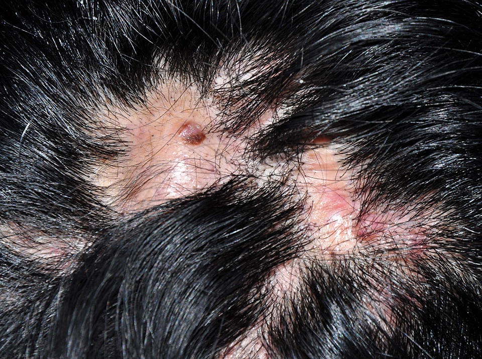 Foliculitis Decalvante