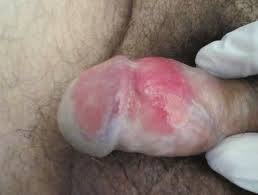 BALANITIS PLASMOCITARIA DE ZOOM