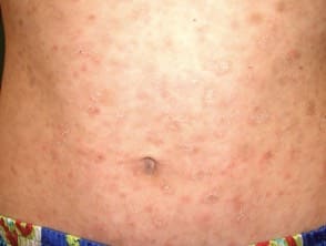 Pitiriasis Liquenoide