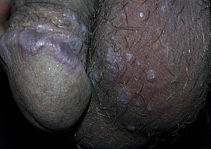 BALANOPOSTITIS POR LIQUEN PLANO