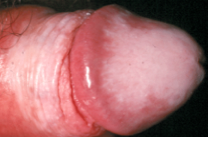 BALANOPOSTITIS POR LIQUEN ESCLEROSO Y ATRÓFICO (LEA)